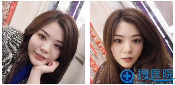 ���ൺҼ������ҽԺ��˫��Ƥ1���»ָ����