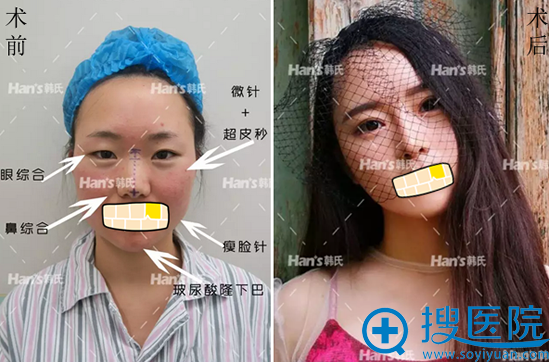济南韩式眼鼻综合整形术前术后对比照片 济南韩式眼鼻综合整形术前术后对比照片
