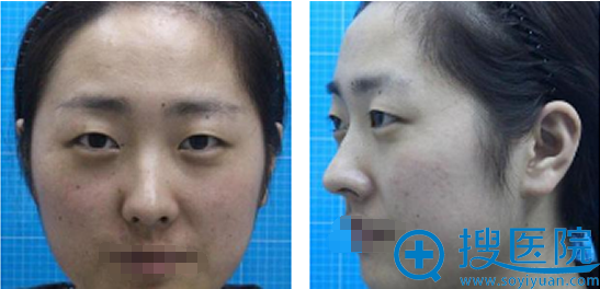 苏州爱思特孙颖双眼皮+开内外眼角术后半年睁眼闭眼恢复照一览