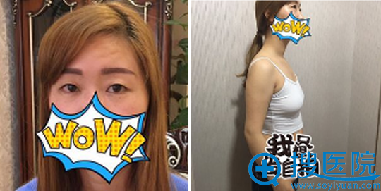 成都星尚美王平切开双眼皮+假体隆胸手术 15天就让我变得不一样