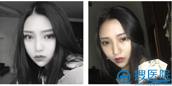 眼综合术后42天恢复照片 眼综合术后42天恢复照片