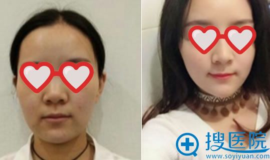 <!--<i data=20240710 data-id=11282></i>-->面部线雕提升案例 <!--<i data=20240710 data-id=11282></i>-->面部线雕提升案例