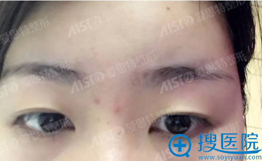 看了美女无锡爱思特的双眼皮术后照 欧阳黎平和张若梅应该选谁
