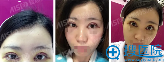 灵韵精雕大眼术术后即刻效果 灵韵精雕大眼术术后即刻效果