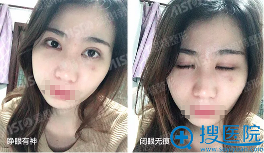 无锡爱思特双眼皮拆线后效果 无锡爱思特双眼皮拆线后效果