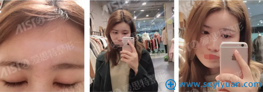 灵韵精雕大眼术术后30天恢复效果 灵韵精雕大眼术术后30天恢复效果