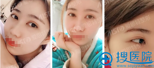 无锡爱思特灵韵精雕大眼术术后照 无锡爱思特灵韵精雕大眼术术后照