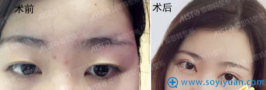无锡爱思特双眼皮术前术后对比 无锡爱思特双眼皮术前术后对比