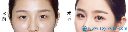 欧阳黎平翘睫无痕大眼术案例 欧阳黎平翘睫无痕大眼术案例