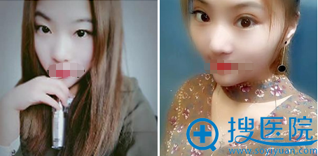 小姐姐切开双眼皮术前术后对比 小姐姐切开双眼皮术前术后对比