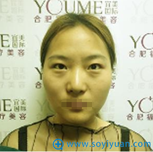 合肥福华赵章杰切开双眼皮手术过程及效果 真人分享更靠谱