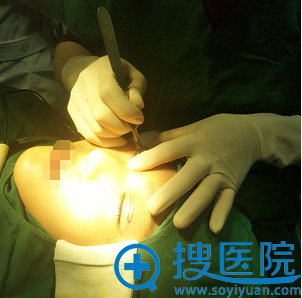 合肥福华赵章杰双眼皮术前画线 合肥福华赵章杰双眼皮术前画线