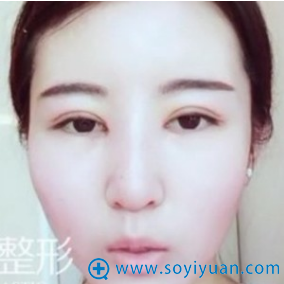 冯守运院长做的双眼皮第8天自拍 冯守运院长做的双眼皮第8天自拍