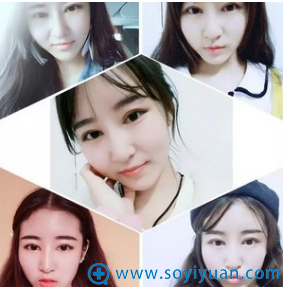 去包头叶子找冯守运做双眼皮2个月了 去包头叶子找冯守运做双眼皮2个月了