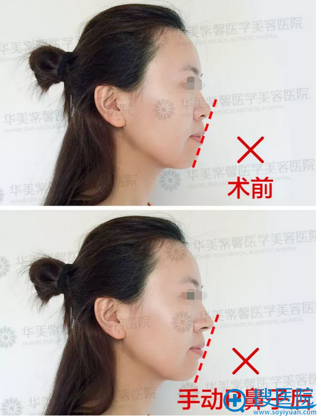 韩国医生河泰源坐诊四川华美紫馨医院,要约隆鼻下巴整形手术吗