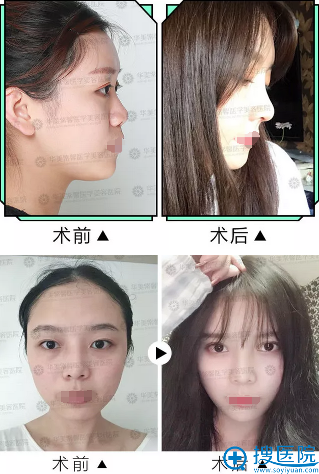 整形前后案例对比 整形前后案例对比