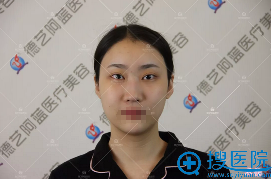 隆鼻术前塌鼻、鼻小柱短 隆鼻术前塌鼻、鼻小柱短