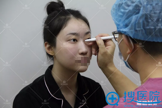 隆鼻术前画线设计 隆鼻术前画线设计