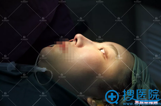 <!--<i data=20240710 data-id=16802></i>-->3D全息综合精雕鼻术后即刻效果 <!--<i data=20240710 data-id=16802></i>-->3D全息综合精雕鼻术后即刻效果