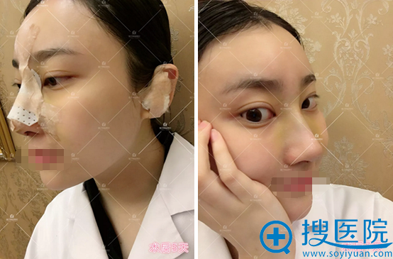 德艺阿蓝<!--<i data=20240710 data-id=16802></i>-->隆鼻手术恢复过程 德艺阿蓝<!--<i data=20240710 data-id=16802></i>-->隆鼻手术恢复过程