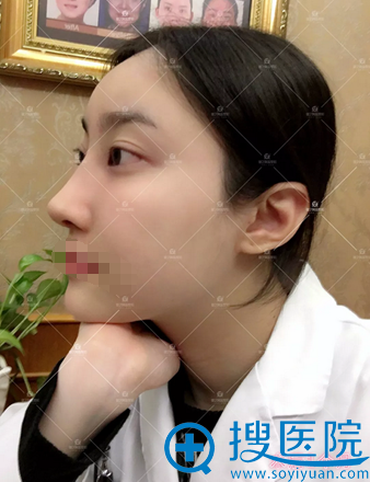 <!--<i data=20240710 data-id=16802></i>-->鼻综合术后一个月恢复效果 <!--<i data=20240710 data-id=16802></i>-->鼻综合术后一个月恢复效果