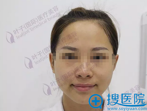 长沙叶子蒋新力院长假体隆下颏手术全记录 让你正确get小v脸
