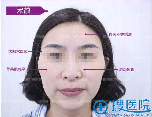 30岁宝妈在济南瑞丽通过面部脂肪填充找回青春