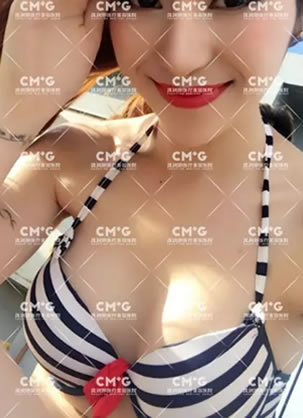 邯郸凯润婷整形医院自体软黄金移植丰胸手术过程及真人案例图