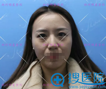 郑州明星整形的孟明星不但双眼皮做的好,面部脂肪填充也不赖