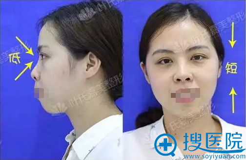桂林叶氏嘉美叶向东假体隆鼻+假体丰下巴术后恢复效果分享