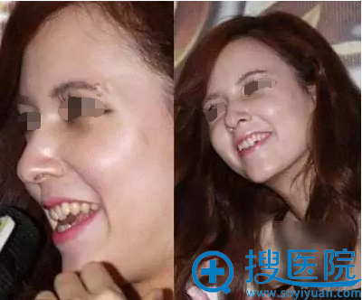 你的牙齿发黄呈几号色?合肥华美教您快速美白牙齿的方法