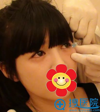 榆林博爱注射玻尿酸手术过程 榆林博爱注射玻尿酸手术过程
