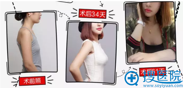 重庆当代假体丰胸案例 重庆当代假体丰胸案例