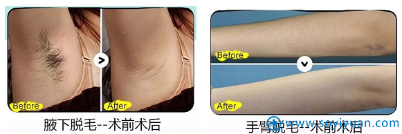 重庆当代整形脱毛真实案例 重庆当代整形脱毛真实案例