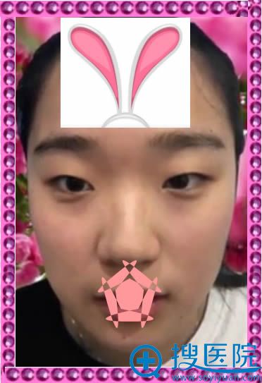 我认为沈阳腾采整形孟强割的切开双眼皮和隆鼻效果很不错
