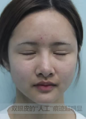 桂林华美员工的双眼皮修复之路 6度媚眼术4天让失败疤痕消失