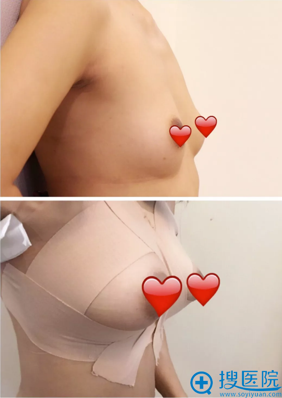做完假体隆胸即刻站立效果对比图 做完假体隆胸即刻站立效果对比图