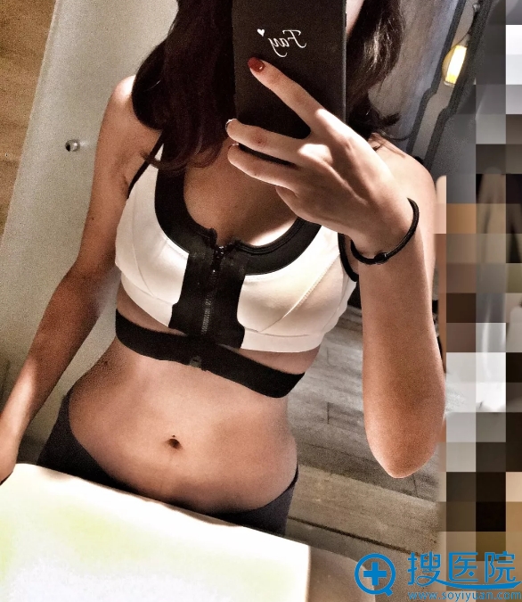 青岛华颜美假体隆胸真人案例 青岛华颜美假体隆胸真人案例