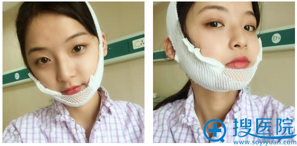 找上海华美李志海做下颌角5天恢复情况 找上海华美李志海做下颌角5天恢复情况