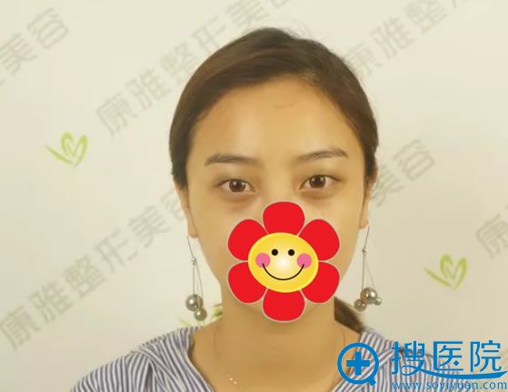 <!--<i data=20240710 data-id=12505></i>-->双眼皮手术代言人 <!--<i data=20240710 data-id=12505></i>-->双眼皮手术代言人