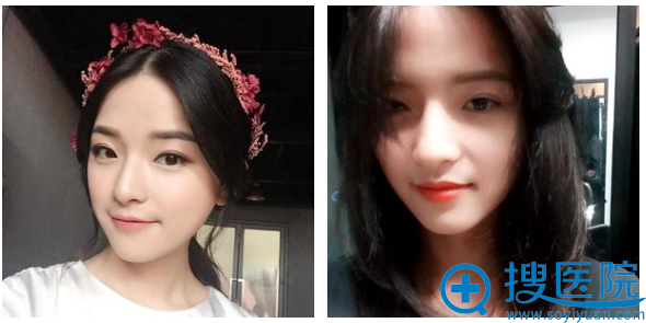 李志海下颌角案例术后33天自拍 李志海下颌角案例术后33天自拍