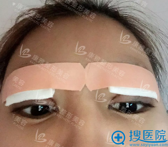 双双做芭比美眼手术第1天效果 双双做芭比美眼手术第1天效果