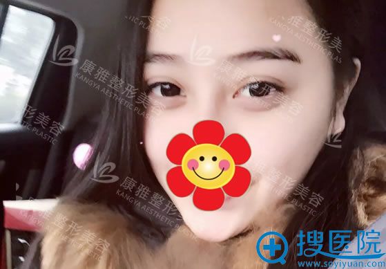 芭比双眼皮手术半个月恢复照 芭比双眼皮手术半个月恢复照