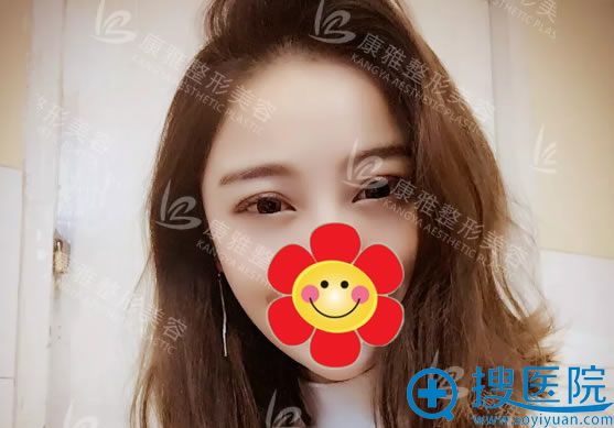 双眼皮手术2个月恢复效果图片 双眼皮手术2个月恢复效果图片