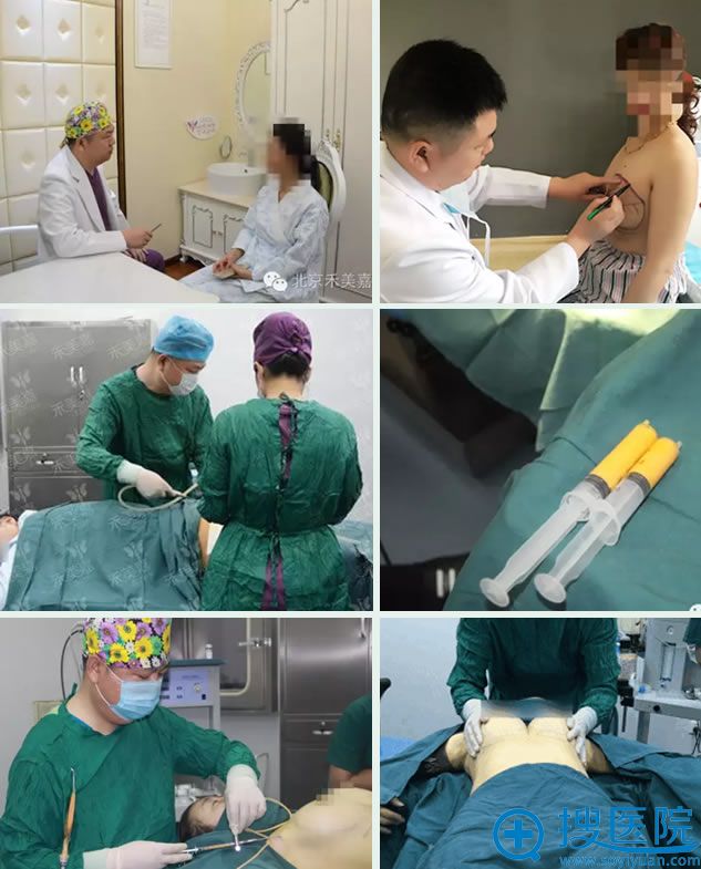 北京禾美嘉任学会自体脂肪隆胸过程 北京禾美嘉任学会自体脂肪隆胸过程