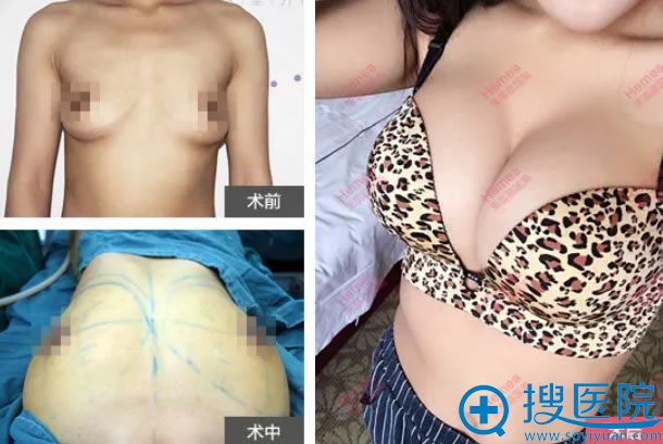 禾美嘉任院长自体脂肪丰胸案例 禾美嘉任院长自体脂肪丰胸案例
