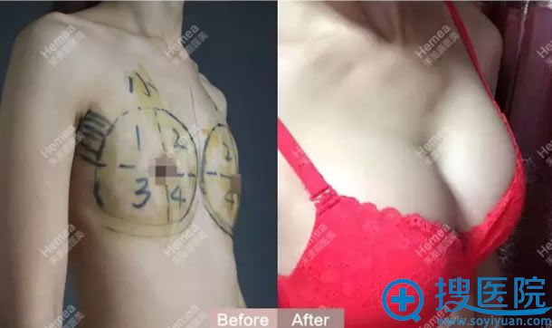 禾美嘉自体脂肪丰胸效果对比图 禾美嘉自体脂肪丰胸效果对比图