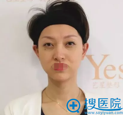 面部松弛下垂怎么矫正?成都艺星注射玻尿酸案例让你拥有女神颜