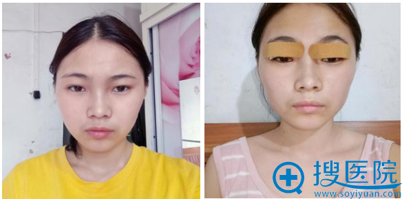距离我找重庆华美整形医院杨丽萍医生割完双眼皮已经8天了