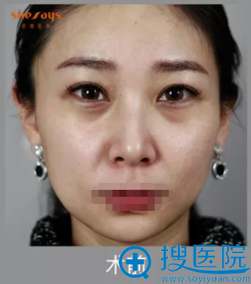 成都西婵熊猫针去黑眼圈+玻尿酸填充面部 一个月她就不一样了